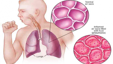 নিউমোনিয়া সামাল দিবেন যেসব উপায়ে