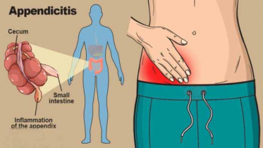 অ্যাপেনডিসাইটিসের ব্যথা চিনবেন যেভাবে