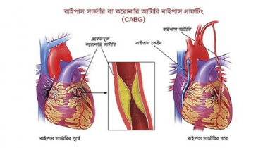 এনজিওপ্লাস্টি ও বাইপাস : কোনটি কখন?