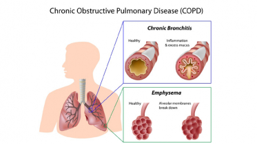 সিওপিডি বা ফুসফুসের রোগ