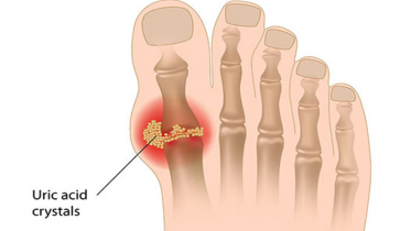 ইউরিক এসিড কি, কেনো হয়, করণীয়